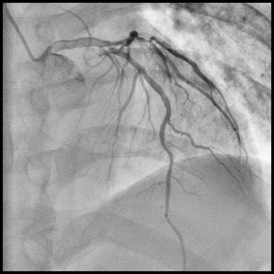 angiography system angiography system