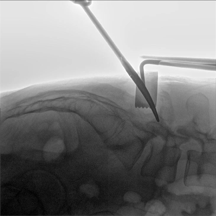 C Arm Fluoroscopic Machine